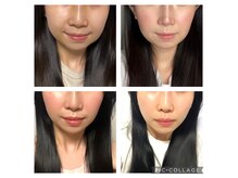 クリメディカルサロン(KURI MEDICAL SALON)の雰囲気（インディバで術後ケアをしています）