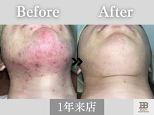 ビューティーアンドボディメイクBB シャオ西尾店/脱毛だけじゃなく肌質改善も◎