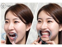 ライトケアサロン 表参道店(Light Care Salon)/５　オープナーを装着