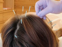 トーリ 代官山(taulli)/眼精疲労に頭皮鍼【代官山/鍼】