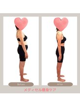 トレゾアスィス(Tresor sis)/痩身/ダイエット/筋膜リリース