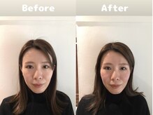 くにたちNyan鍼灸整体院/【小顔矯正】Before After 5