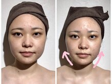 ウィクシム(Wixim)/小顔コルギ1回施術