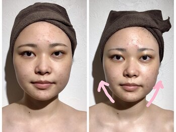 ウィクシム(Wixim)/小顔コルギ1回施術