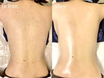 クク(ququ)/背中ピーリングトリートメント