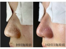 シエール 調布(Ci'aile)/本気の毛穴肌質改善