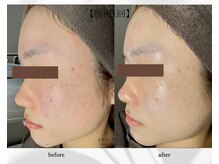アン ビューティー(ann beauty)/施術1回【症例写真】20代