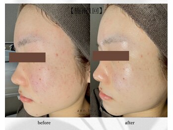 アン ビューティー(ann beauty)/施術1回【症例写真】20代