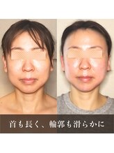 バンブー(bamboo)/エラはり滑らかフェイスライン