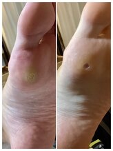 ドクターネイル爪革命 麻布十番店/【たこ・魚の目ケア】フットケア