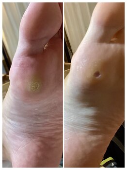 ドクターネイル爪革命 麻布十番店/【たこ・魚の目ケア】フットケア