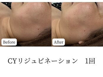 マテオ(Matteo)/CYリジュビネーション