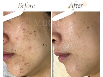ミラリー(MIRALY)/頬～顎ニキビケア6ヶ月(30代)