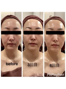 リッシュ(RICHE)/レモンボトルbefore→after