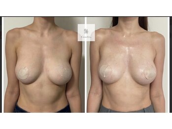 エルミナ.(elmina.)/ボリュームUP！クーパー靭帯修復