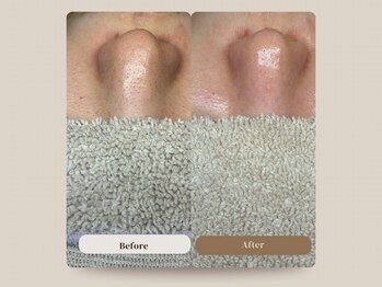 ジーンバイピエル 中野店(gene by PIEL)の写真/【鼻黒ずみケア&頬レッドショット(レモンボトル進化版)】10年悩んだ毛穴が速攻でつるん！【中野】