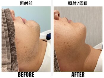 ストック 立花店(STOCK)/【ヒゲ】ヒゲ照射前→7回目