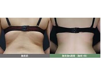 アモ(amo)/背中もスッキリ