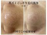 ★人気No.1【黒詰まりゴッソリ★毛穴洗浄】¥5500→3900ポッキリ