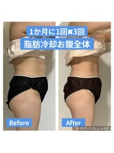 パラアモール(Paraamor)/他の部位も痩せる脂肪冷却