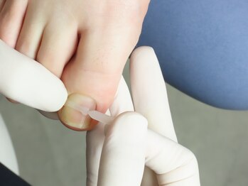 フスフレーゲ 新宿御苑店ルーエ/巻き爪弾性樹脂プレート矯正