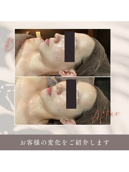肌イズム つくば店(肌ism)/【before&after】ララピール+LDM