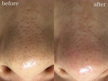 アワピール 天王寺店(AWA PEELL)/毛穴洗浄/天王寺/毛穴洗浄/小顔