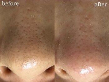 アワピール 天王寺店(AWA PEELL)/毛穴洗浄/天王寺/毛穴洗浄/小顔