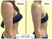 アオレニア(ao.lenia)/二の腕セル脂肪ケア♪ブライダル