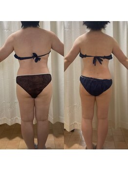 エン ボディアンドフェイシャル(En)/NEW☆ハイパーナイフ痩身・全身