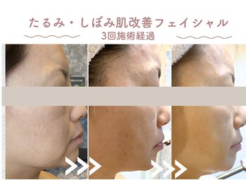 エステティックサロン シーズ/フェイスライン改善