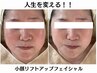 【エステ小顔人気No1☆】人生を変えるうる艶肌!!!私史上最高の小顔美人に♪