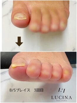 I-127 巻いた爪の改善　フット