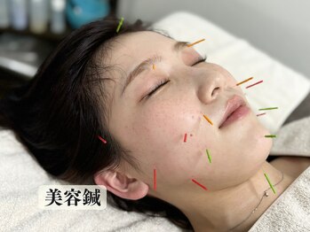 ハリシェンド/《美容鍼》