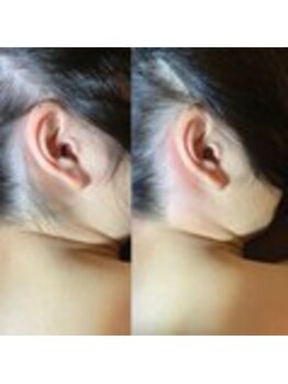 ブラジリアンワックス脱毛専門店 ヴァージン ワックス 新宿店(Virgin Wax)/【うなじ】ビフォーアフター