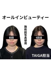 クリアランス(CLEARANCE)/施術回数6回　TAIGA担当