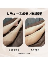 トリプルワン(111)/レディースボディWAX脱毛