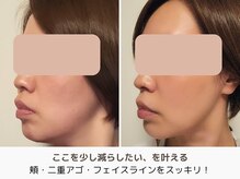 アントルーチェ 代々木上原(Entluce.)/美容鍼サロンでもこれだけ変わる