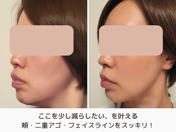 アントルーチェ 代々木上原(Entluce.)/美容鍼サロンでもこれだけ変わる