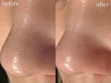 アワピール 天王寺店(AWA PEELL)/毛穴洗浄/天王寺/毛穴洗浄/小顔