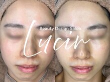 ルシール 仙台店(lucir)/<乳酸ピール> Before/After