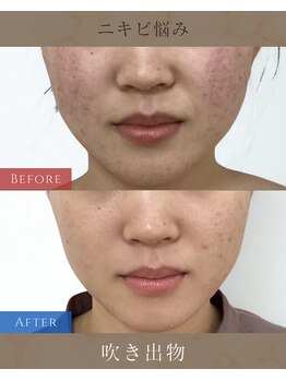けいのき鍼灸整骨院の写真/繰り返す肌悩みに美容鍼！血流UPでニキビ・毛穴をケアし潤う素肌美肌へ♪