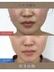 けいのき鍼灸整骨院の写真/繰り返す肌悩みに美容鍼！血流UPでニキビ・毛穴をケアし潤う素肌美肌へ♪