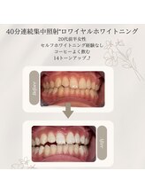 プラスビーセルフ(+b self)/ホワイトニングビフォーアフター