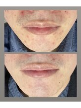 クレヴィー(Creviy)/陶肌トリートメント1回