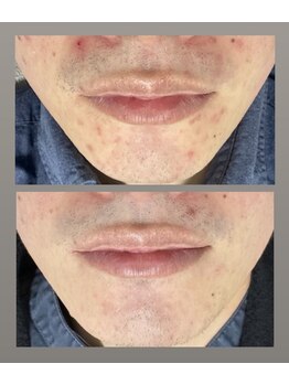 クレヴィー(Creviy)/陶肌トリートメント1回