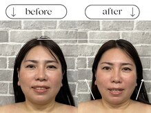 ビースタイル(B-style)/【電気美容鍼】ビフォーアフター