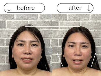 ビースタイル(B-style)/【電気美容鍼】ビフォーアフター