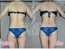 グラウディア 恵比寿/痩身/筋膜リリース/インディバ超