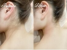 ピミル(PIMIL)/うなじ脱毛